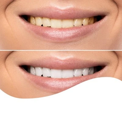 Splendid White Teeth Whitening Wraps 7 Day Treatment  Up&Up™