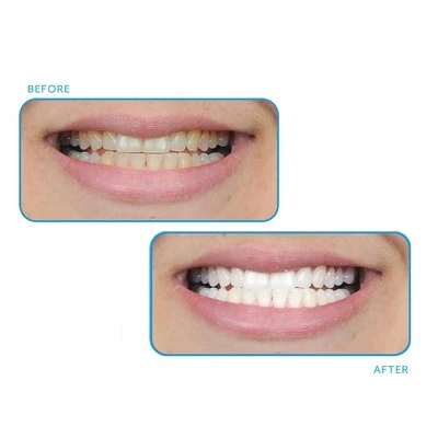 GO SMILE Tooth Whitening System